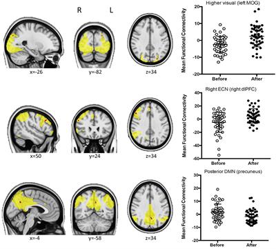 Coffee consumption decreases the connectivity of the posterior Default Mode Network (DMN) at rest